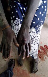A woman bitten by a suspected rabid dog in West Pokot
